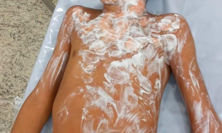 crianca_queimada_widelg